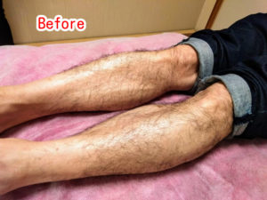 男性シュガーリング体験者( Before)